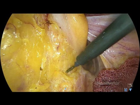 TME laparoscopique sans stomie, anastomose coloanale Turnbull-Cutait en deux étapes pour le cancer rectal supranal