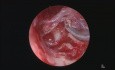 Cholestéatome exclusivement pour la chirurgie endoscopique de l'oreille