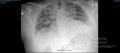 Radiographie thoracique d'un patient COVID-19 (2)