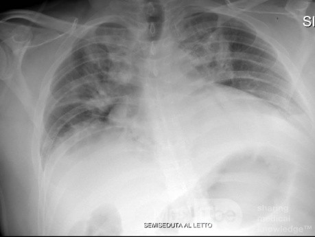 Radiographie thoracique d'un patient COVID-19 (2)