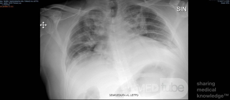 Radiographie thoracique d'un patient COVID-19 (2)