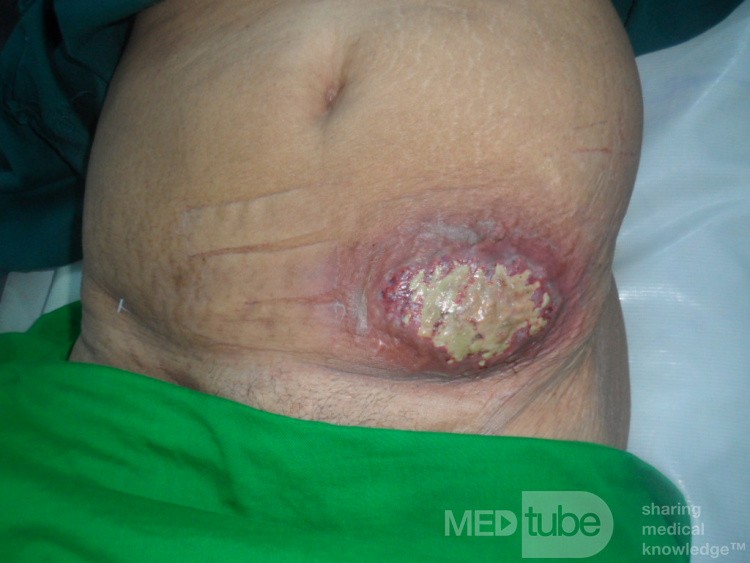 Anthrax staphylococcique chez un patient diabétique. A