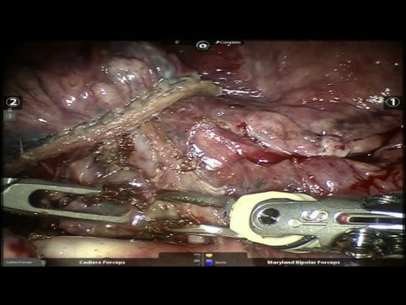 Chirurgie du poumon assistée par robot (après un traitement néoadjuvant)