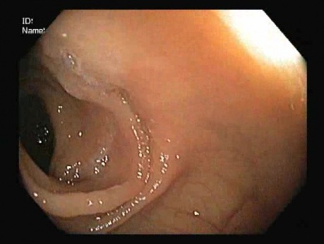 Agrafage Circulaire Endoscopique des Hémorroides sous Eau