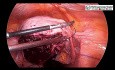 Prise en charge laparoscopique du fibrome intramural postérieur