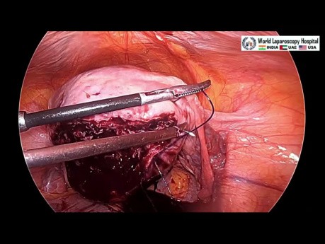 Prise en charge laparoscopique du fibrome intramural postérieur