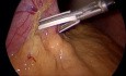 Gastrectomie Sleeve Laparoscopique à Trois Trocarts