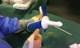 Procédure DG HAL-RAR - Traitement des piles (hémorroïdes) sans excision