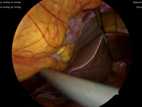 Mobilisation Oesophagienne Jusqu'aux Ganglions Lymphatiques Sous-Carénaires