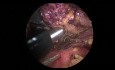 Thymectomie par thoracoscopie vidéo-assisté du côté gauche en utilisant la technique de transcollation