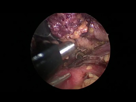 Thymectomie par thoracoscopie vidéo-assisté du côté gauche en utilisant la technique de transcollation