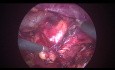 Chirurgie laparoscopique rétropéritonéale pour l'ablation d'une tumeur rénale
