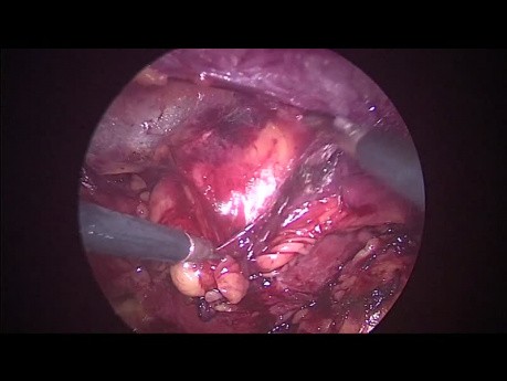 Chirurgie laparoscopique rétropéritonéale pour l'ablation d'une tumeur rénale