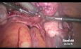 Ligature temporaire de l'artère utérine à l'aide du nœud «lacet de chaussure» avant la myomectomie laparoscopique 