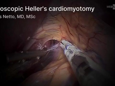 Cardiomyotomie de Heller Laparoscopique