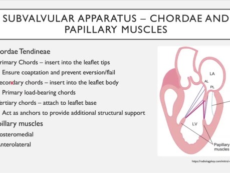 Prolapsus Valvulaire Mitral (PVM) et Disjonction Annulaire Mitrale (DAM)