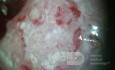 Colposcopie - Carcinome Epidermoïde Invasif