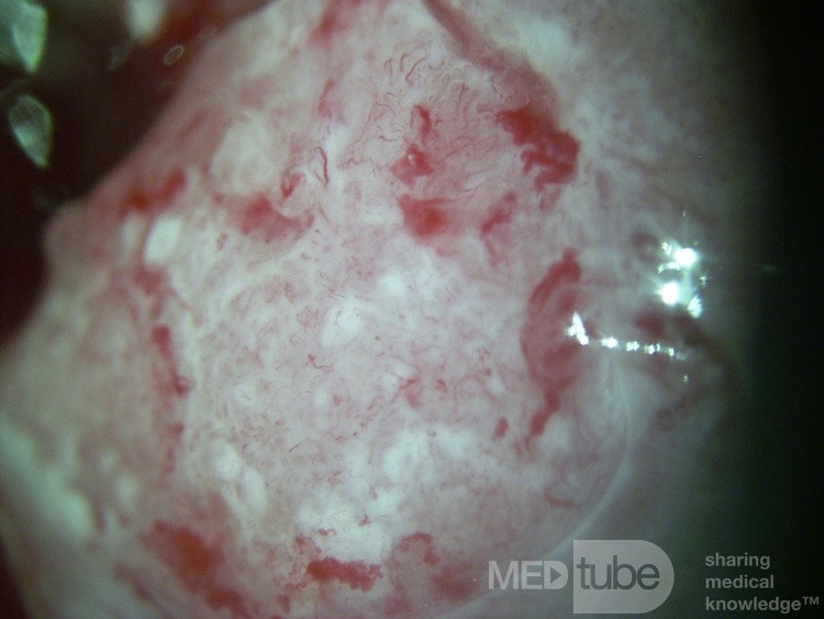 Colposcopie - Carcinome Epidermoïde Invasif