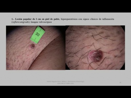 Tumeur de la vulve • Site médical MEDtube.fr