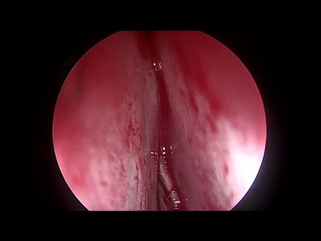 Septoplastie Endoscopique pour Déviation Septale