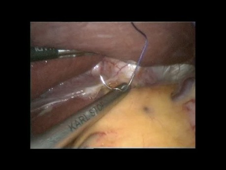 Gastrectomie totale avec curage ganglionnaire de type D2 par voie laparoscopique