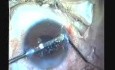 Phacoémulsification et pose d'un implant intraoculaire
