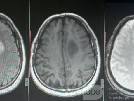 Planification Chirurgicale avec Neuronavigation chez un Patient présentant une Masse Intracrânienne. Gliome de haut grade.