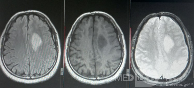 Planification Chirurgicale avec Neuronavigation chez un Patient présentant une Masse Intracrânienne. Gliome de haut grade.