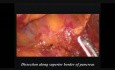 Pancréatectomie subtotale par voie laparoscopique en raison du cystadénome mucineux