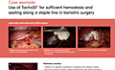 Utilisation de TachoSil® en Chirurgie Bariatrique pour une Hémostase et une Etanchéité Suffisantes lors de la Gastrectomie Laparoscopique