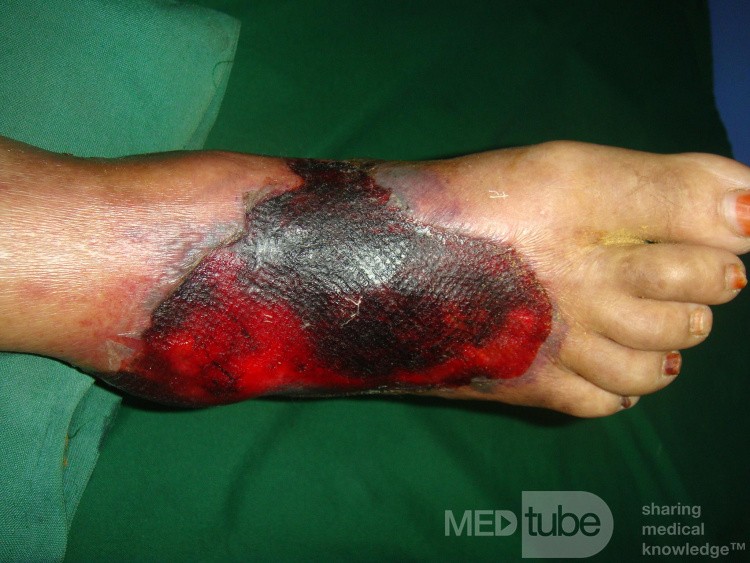 Le pied diabétique - une blessure après un bandage trop serré. 1