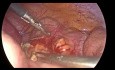 Appendicectomie Laparoscopique - femme enceinte