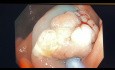 Résection muqueuse endoscopique du petit polype plat caecum