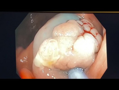 Résection muqueuse endoscopique du petit polype plat caecum