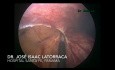 Pneumatose intestinale kystique - Diagnostic différentiel de l'abdomen aigu.