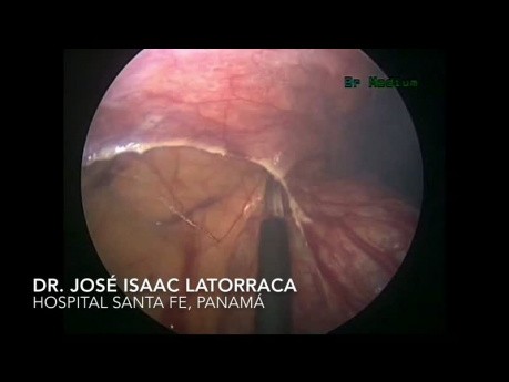 Pneumatose intestinale kystique - Diagnostic différentiel de l'abdomen aigu.