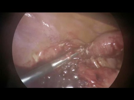 Abces Appendiculaire Traitement Laparoscopique