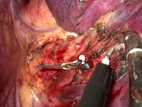 Sous-Segmentectomie Anatomique Antérieure Supérieure Gauche Uniportale S3c Vidéo-Assistée