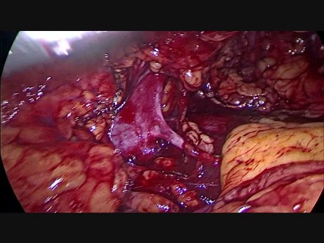 Néphrectomie laparoscopique avec extraction vaginale chez un donneur vivant