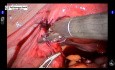 Inversion de la stérilisation tubaire par chirurgie robotisée