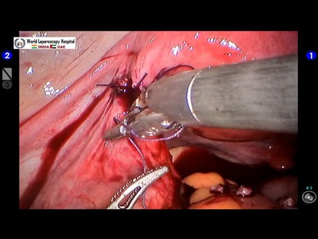 Inversion de la stérilisation tubaire par chirurgie robotisée
