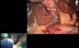 Cholecystektomia z użyciem robota chirurgicznego