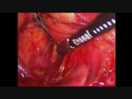 Pancréatectomie distale par voie laparoscopique en raison de la tumeur neuroendocrine du pancréas