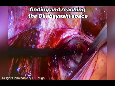 Dissection de l'Espace d'Okabayashi (Espace Pararectal) dans l'Endométriose