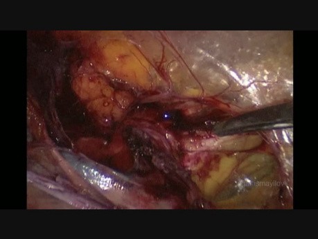 Traitement de hernie İnguinale directe étranglée par voie laparoscopique trans-abdominale pré-péritonéale (TAPP)
