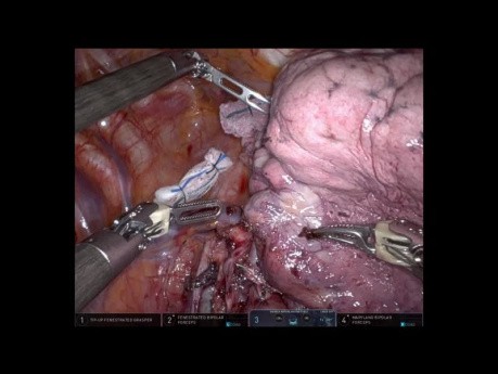 Segmentectomie robotique du lobe supérieur droit S2