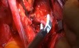 Hystérectomie radicale résection du ligament cardinal (paramètres latéraux)