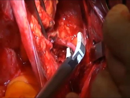 Hystérectomie radicale résection du ligament cardinal (paramètres latéraux)