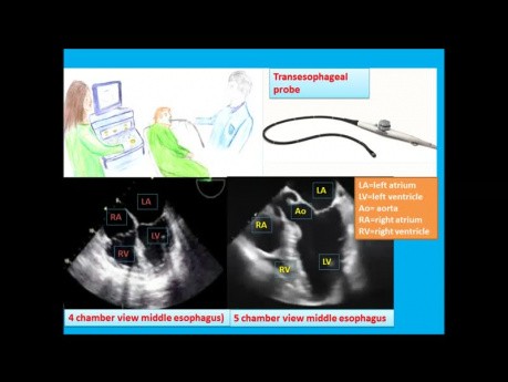 Quiz d'échocardiographie transœsophagienne et une introduction aux vues en ETT (orteil)