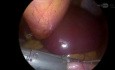 Gastrectomie Sleeve Laparoscopique